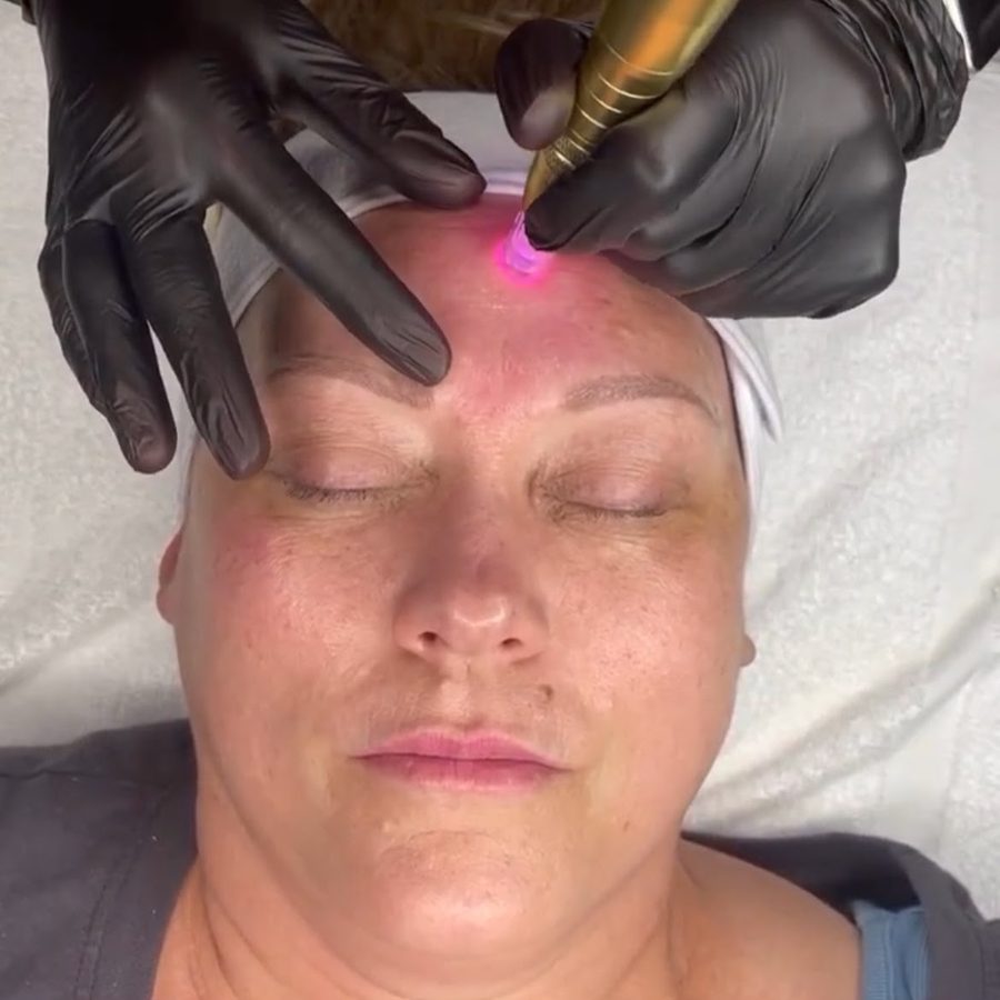 Advanced microneedling or corrective facial treatment at Awaken Zen Spa in Mesa, AZ