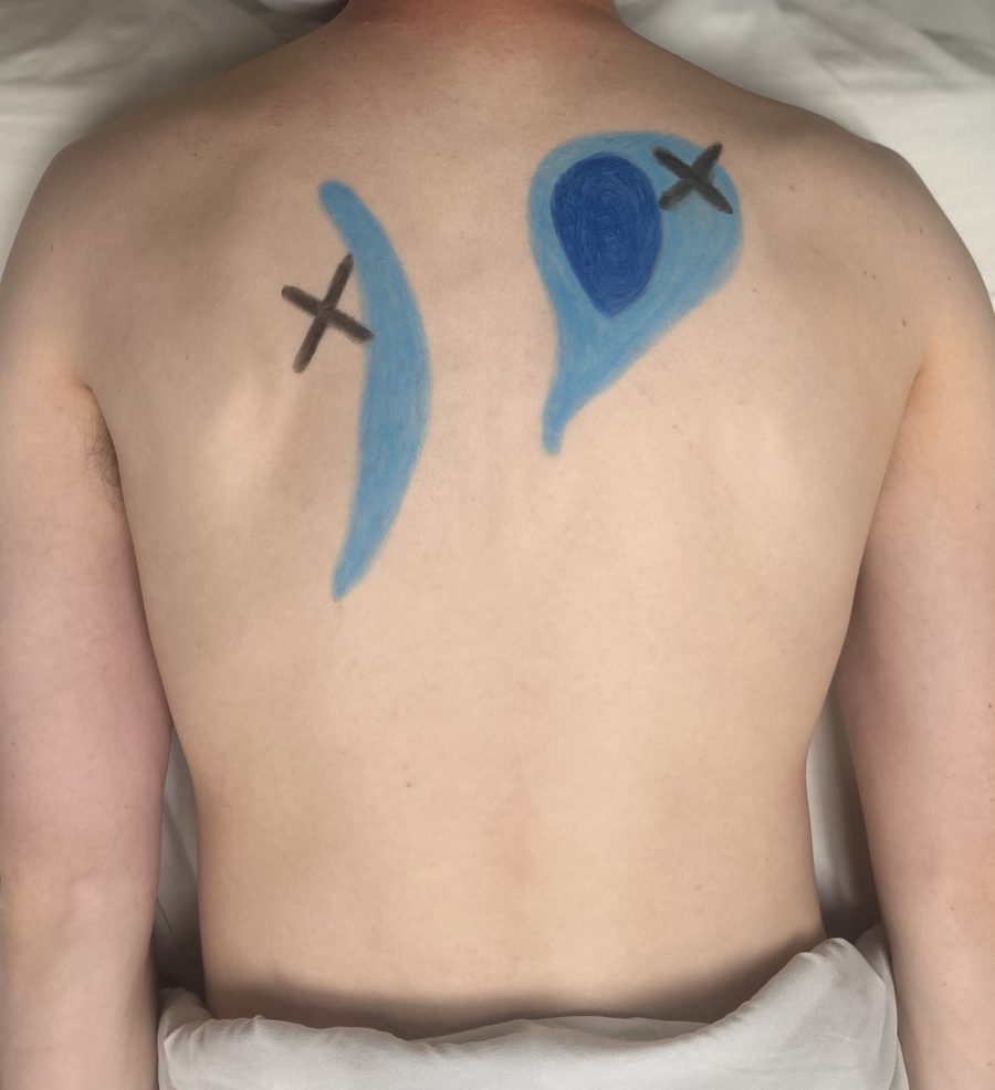 Zen Mend injury focused trigger point therapy with referral pain pattern mapped on client's back at Awaken Zen Spa in Mesa, AZ